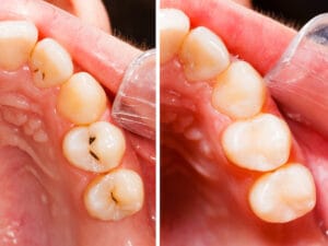 Composite Fillings Orig