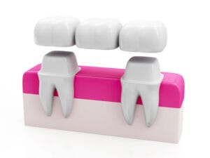 Dental Bridge Orig