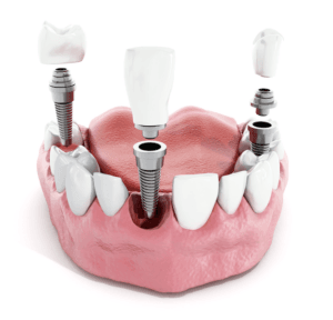 Dental Implant Restoration 2 Orig