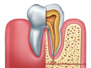 Root Canal Orig