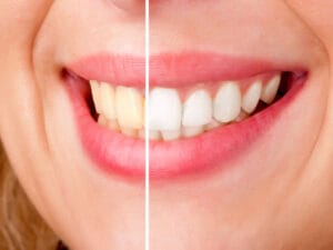 Teeth Whitening Orig